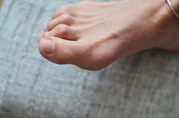 Foot that has bunion