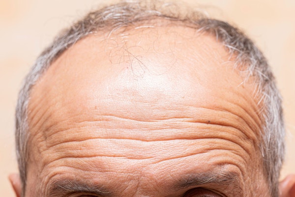 Mature man's forehead lines
