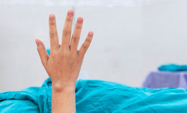 Person's ganglion cyst on hand before surgery