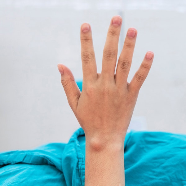 Person's ganglion cyst on hand before surgery