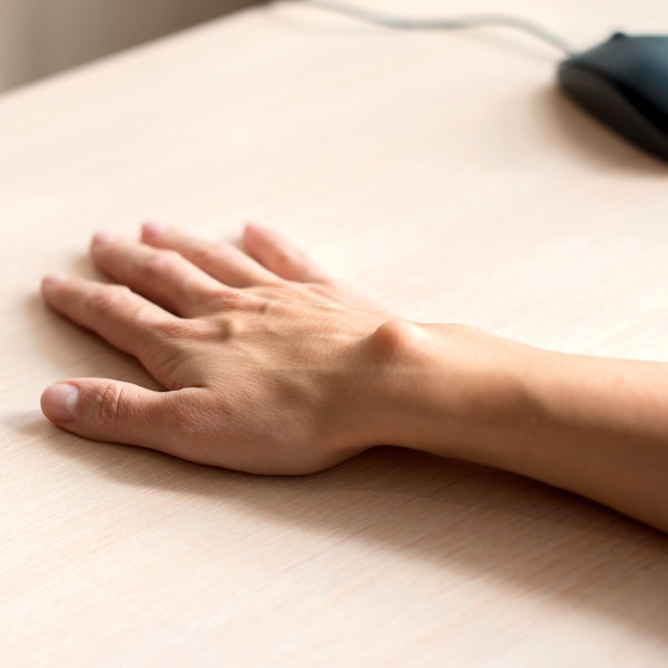 Hand with ganglion cyst while working on computer