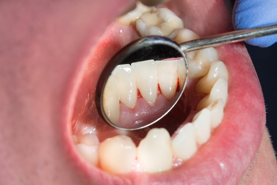 Inflamation on the gum lin from gingivitis
