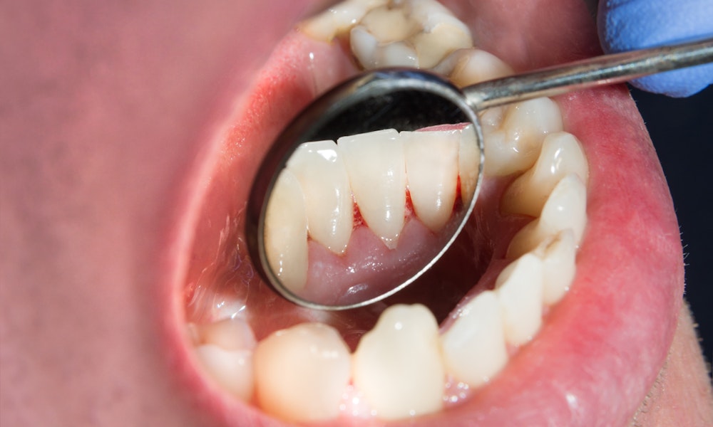 Inflamation on the gum lin from gingivitis