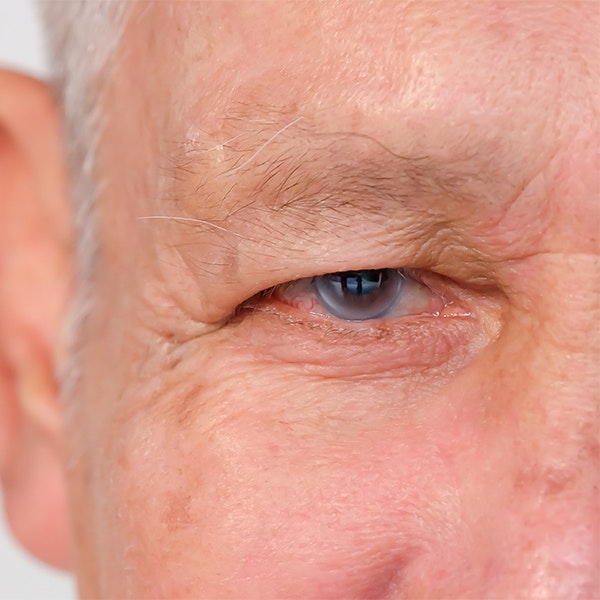 man with glaucoma