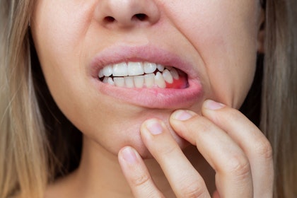 Woman with bleeding gums