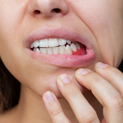 Woman with bleeding gums