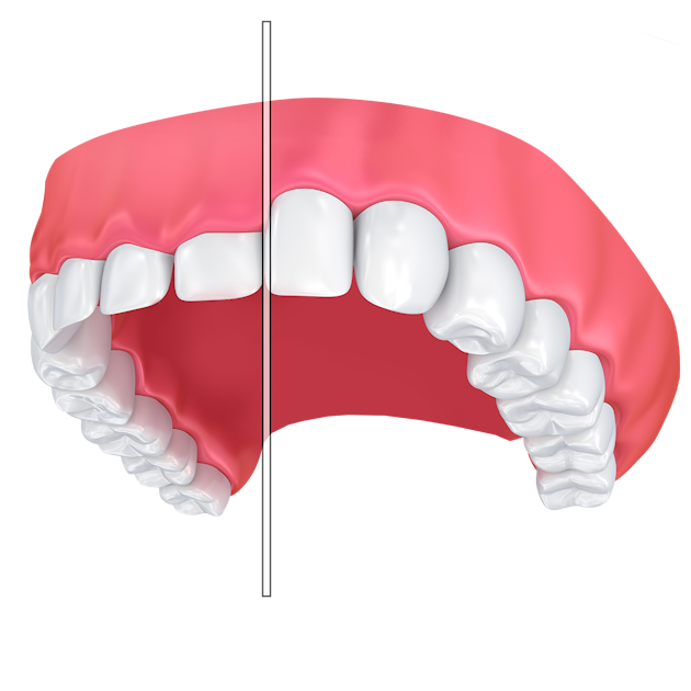 Illustration of before and after gum contouring