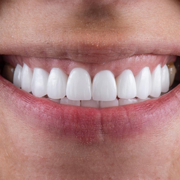 Teeth in need of gum contouring