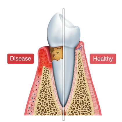 Root Plan Scaling and Root Planing - Merritt Island, FL - Family Dentistry ...