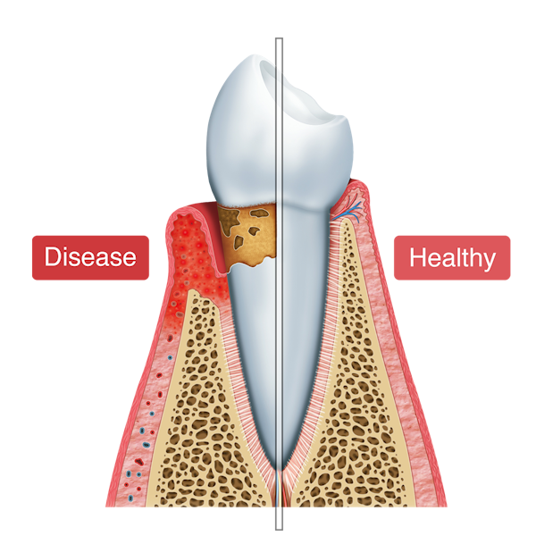 Illustration of a diseased tooth and a healthy tooth.