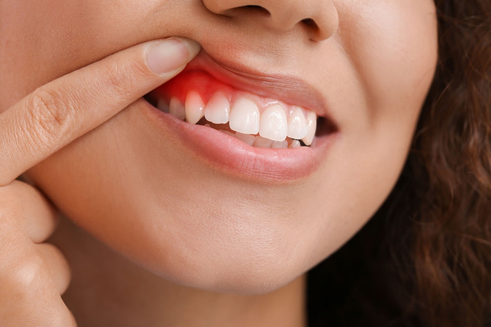 Woman with gum disease