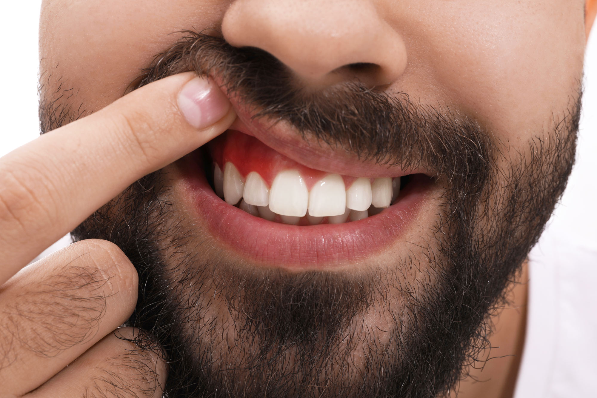 man pulling back upper lip to show inflamed gum tissue