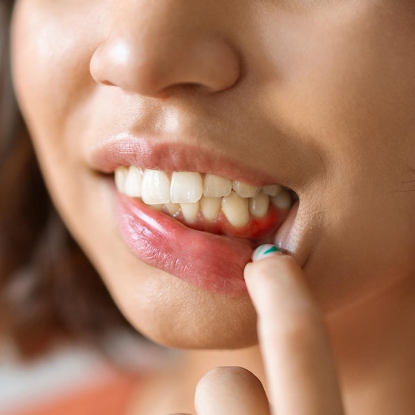 Woman looking at inflamed gums