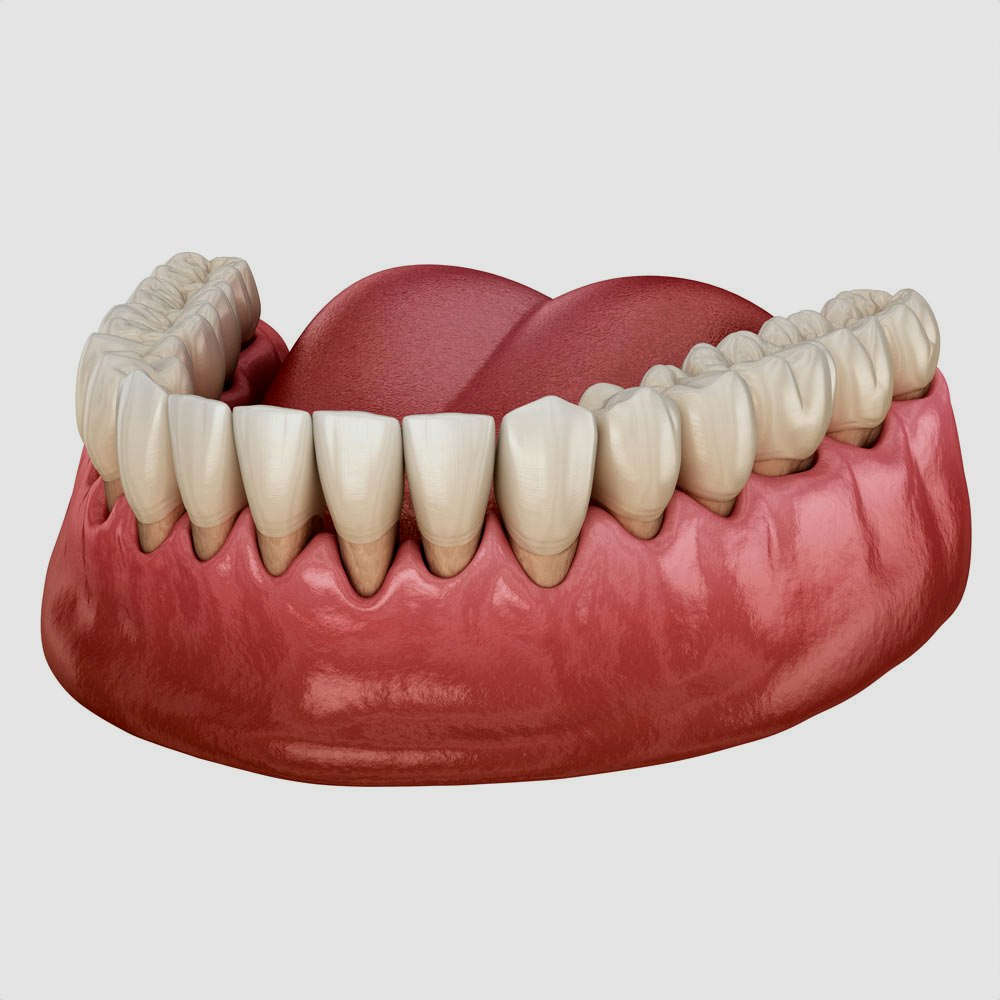 Gum recession