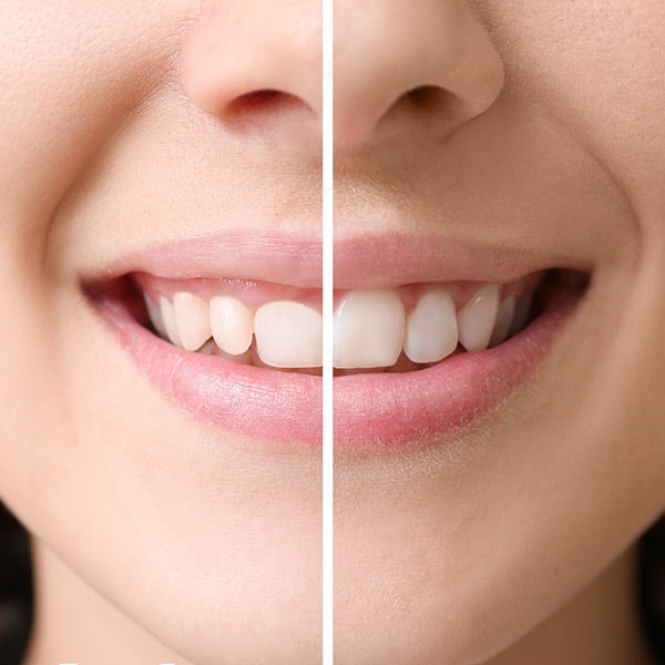 Before and after gum contouring