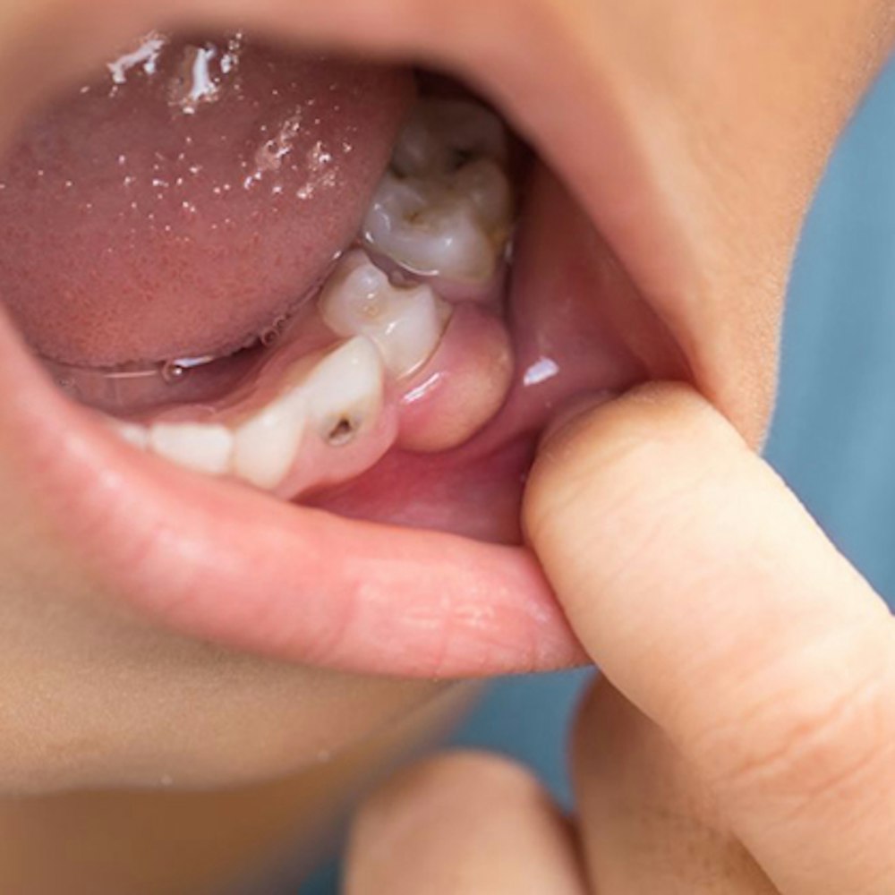 Person with gum disease