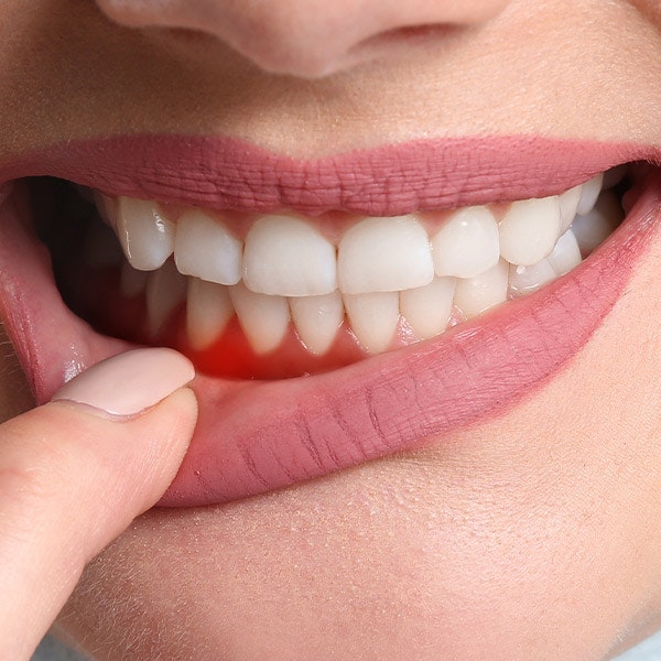 Person with red and inflamed gums