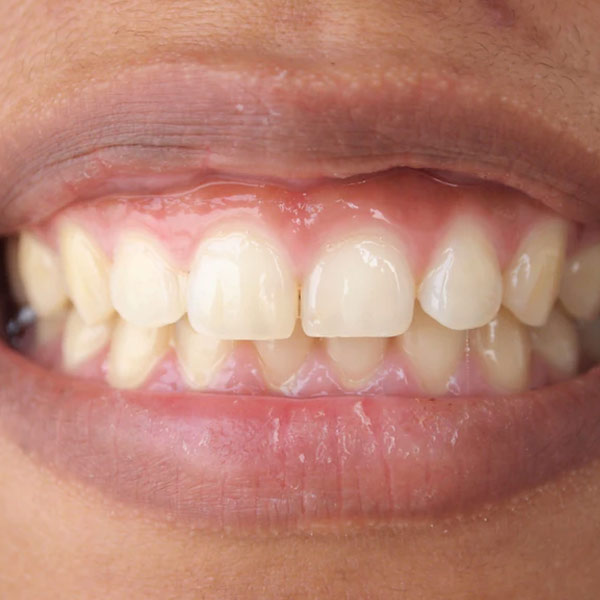 Gummy teeth