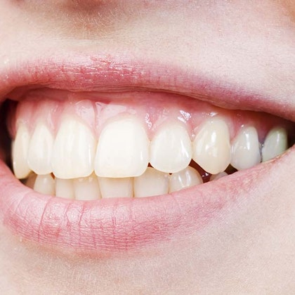 Opaque teeth