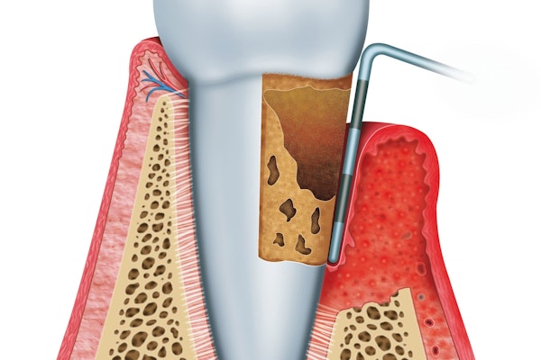 Illustration of periodontal treatment