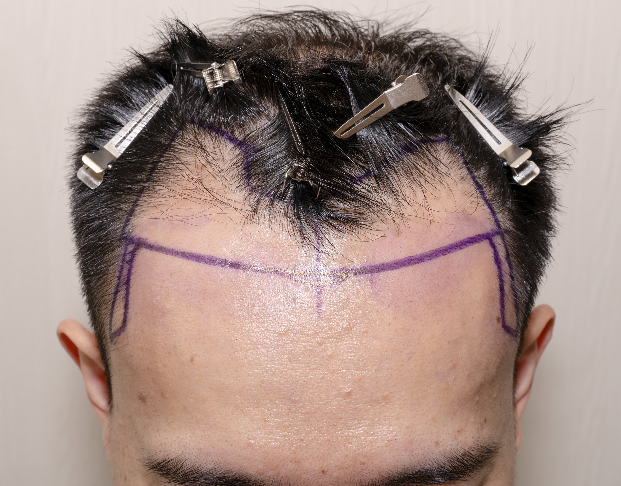 Before hair transplant