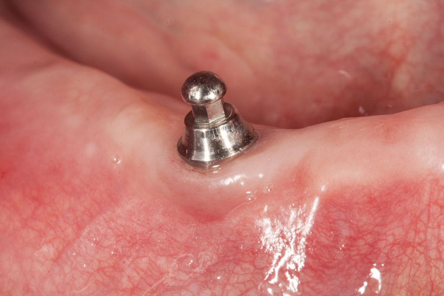Dental implant post in a fully healed jaw