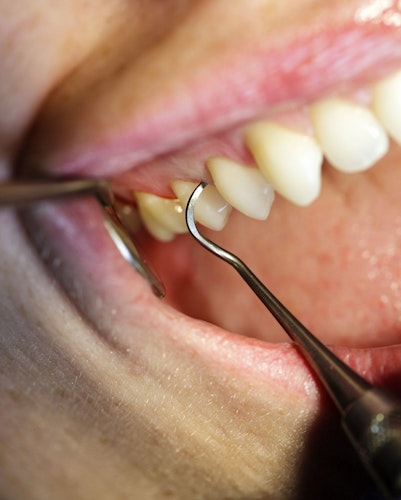Closeup of dental tools cleaning out smile