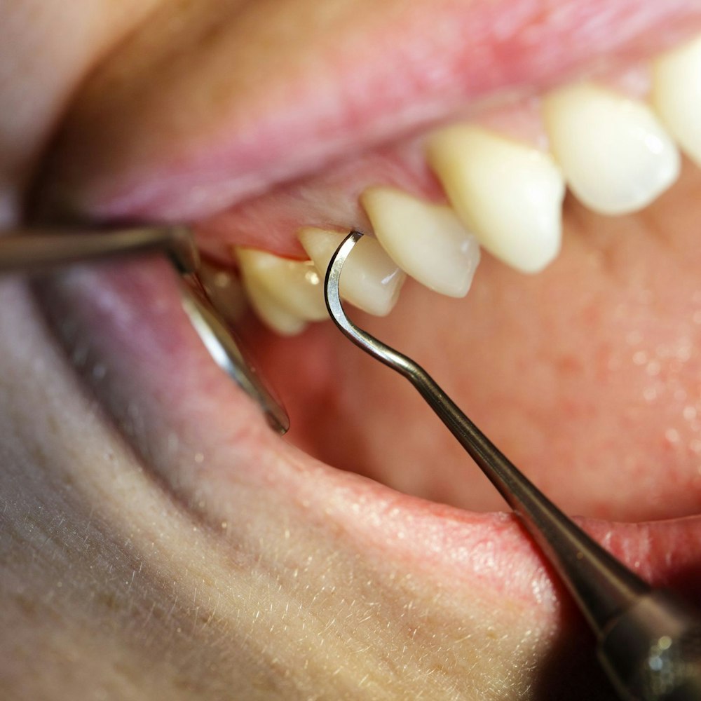 A dental pick scraping the teeth
