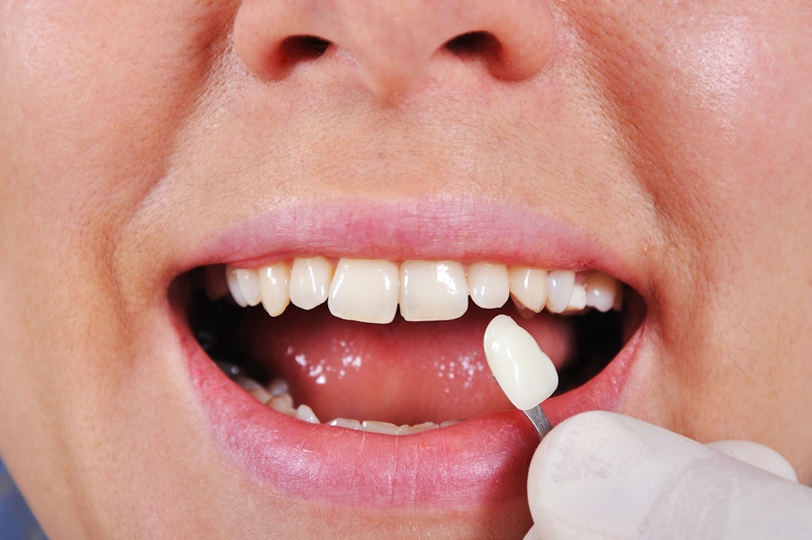 dental veneers