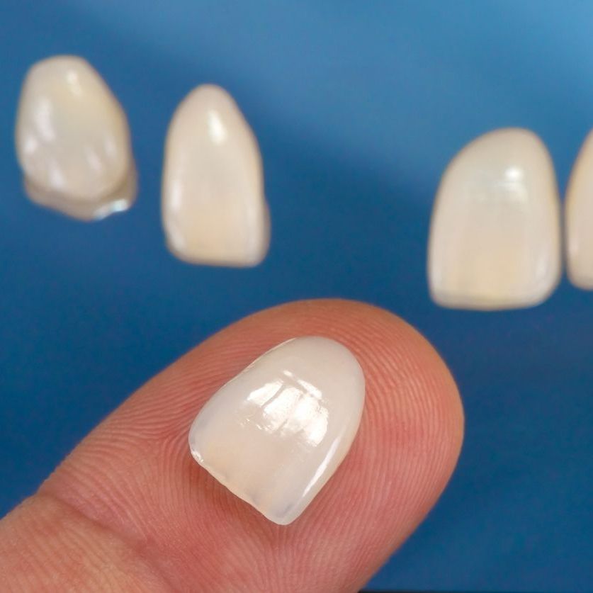 veneers