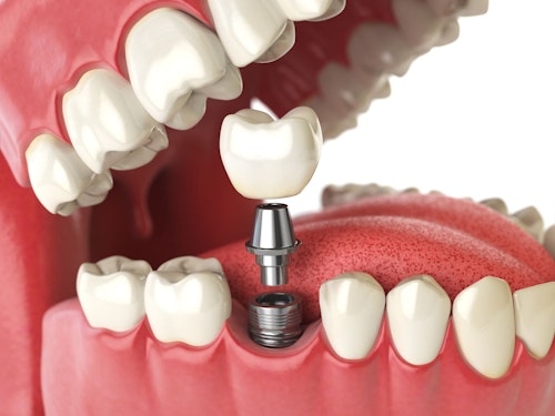 dental implant in a bite