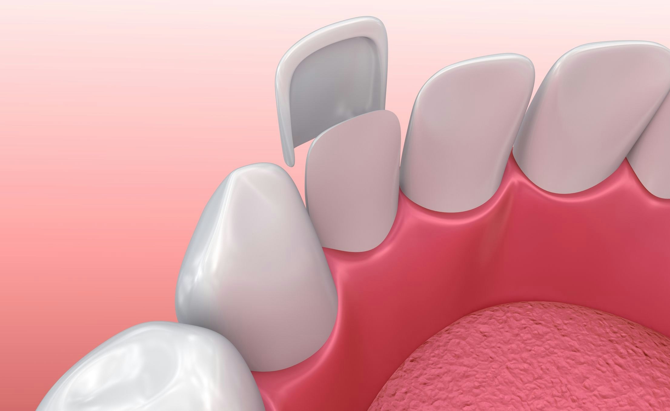 Illustration of porcelain veneer fitted onto tooth
