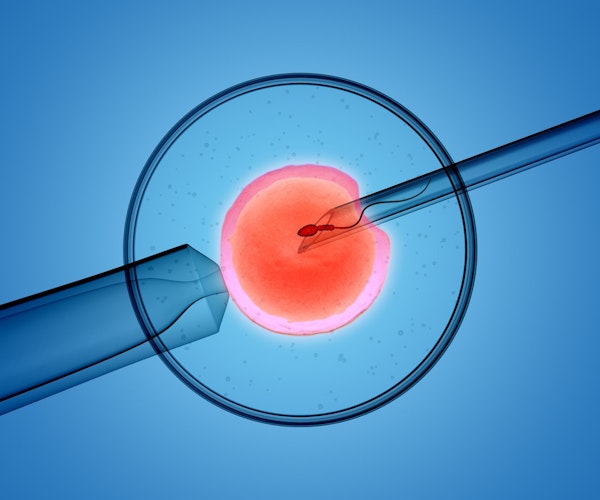 Intracytoplasmic Sperm Injection (ICSI)