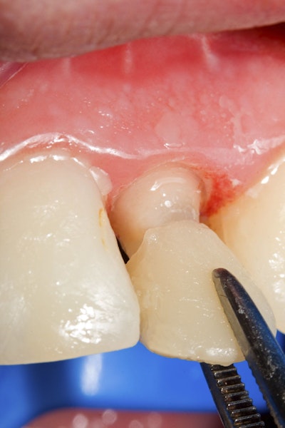 Veneers Victoria, TX Porcelain Veneers Grant Heller, DDS