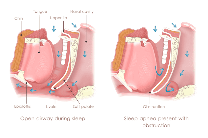 Graphic demonstrating how the airway is blocked off during sleep apnea