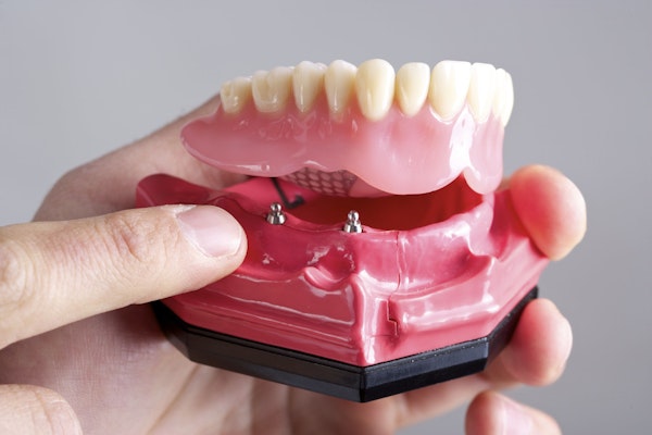 Implant-retained overdenture