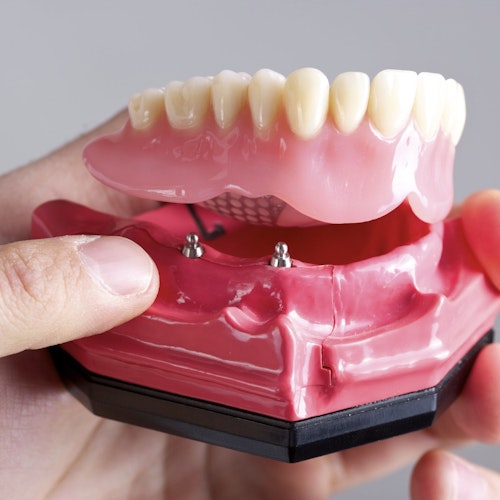 Model of implant denture