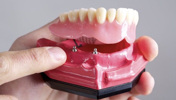 Implant-retained overdenture