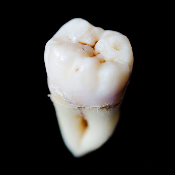 Wisdom Teeth