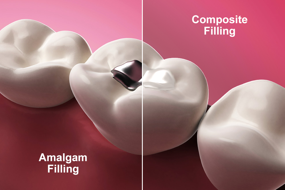 dental fillings