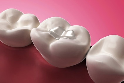 Image of tooth-colored filling