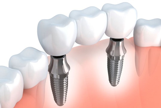 Ilustracion digital mostrando los componentes de un puente soportado por implantes dentales