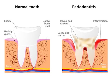 illustration of normal tooth versus periodontitis