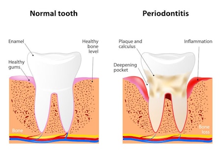 illustration of normal tooth versus periodontitis