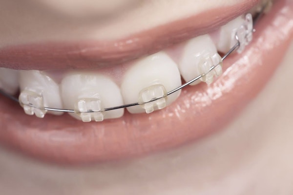 Tooth-colored braces