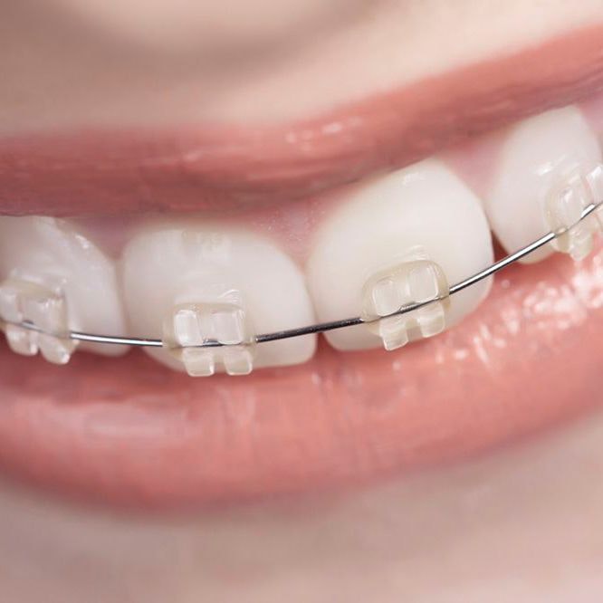 Ceramic braces