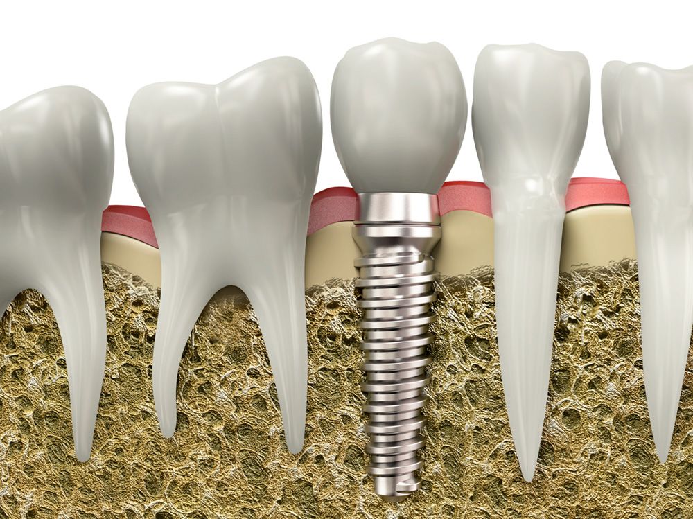 illustration of a dental implant