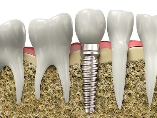 Single tooth implant