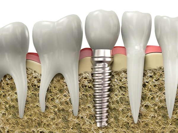 illustration of a dental implant
