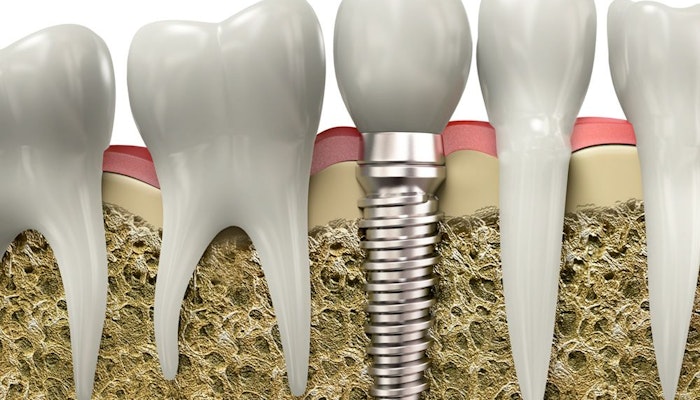 Single tooth implant